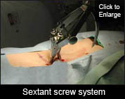 Sextant screw system