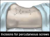Incisions for percutaneous screws